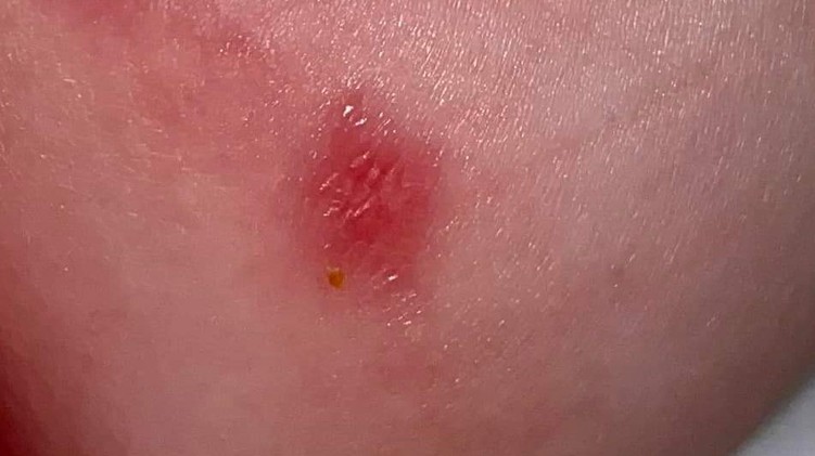 Ekcéma szerű, kicsit hólyagos, hámló kiütések a gyerek bőrén