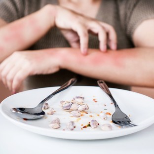 Ételallergia: ilyen, amikor allergiás kiütések jelzik