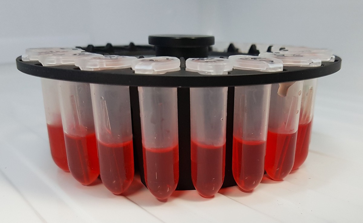 Prosty test może zidentyfikować śmiertelną chorobę serca