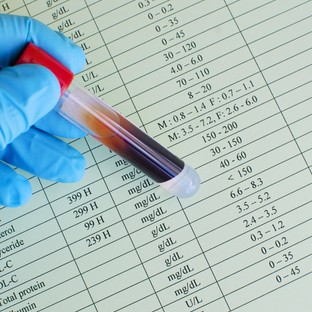 Mit jelent az LDL-koleszterin érték a laborleleten?