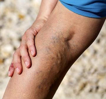 Hogyan fájnak a lábak a visszérrel, elsősegély a fájdalom elleni küzdelemben