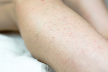 szőrtelenítés, szőrösödés, PCOS, hormonok, tesztorszteron, 