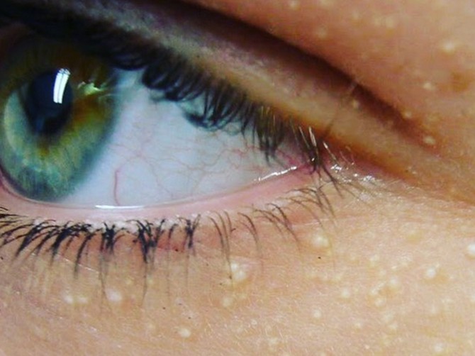 Mnogi misle da su bubuljice i greše