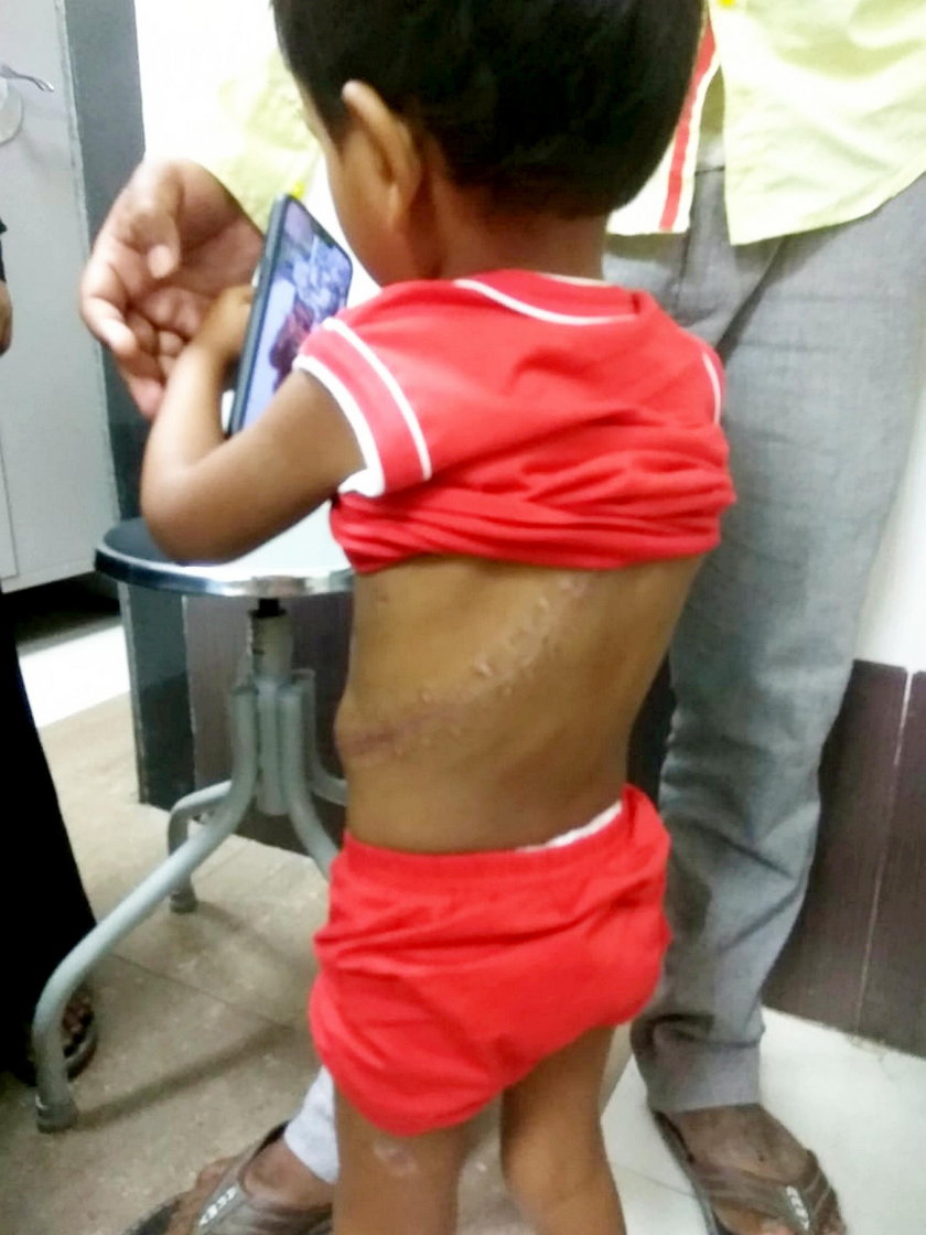 Wstrząsający los 3-letniego maluszka. Przebił go metalowy pręt