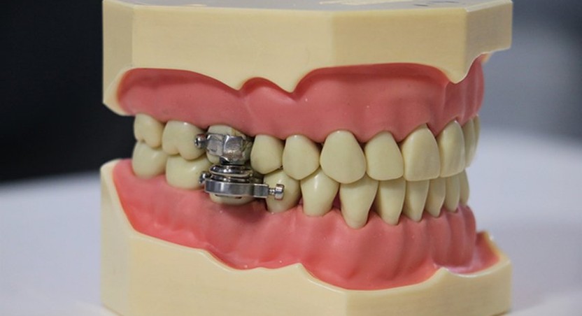 Weight loss device that locks your teeth to stop you from chewing until you become slim