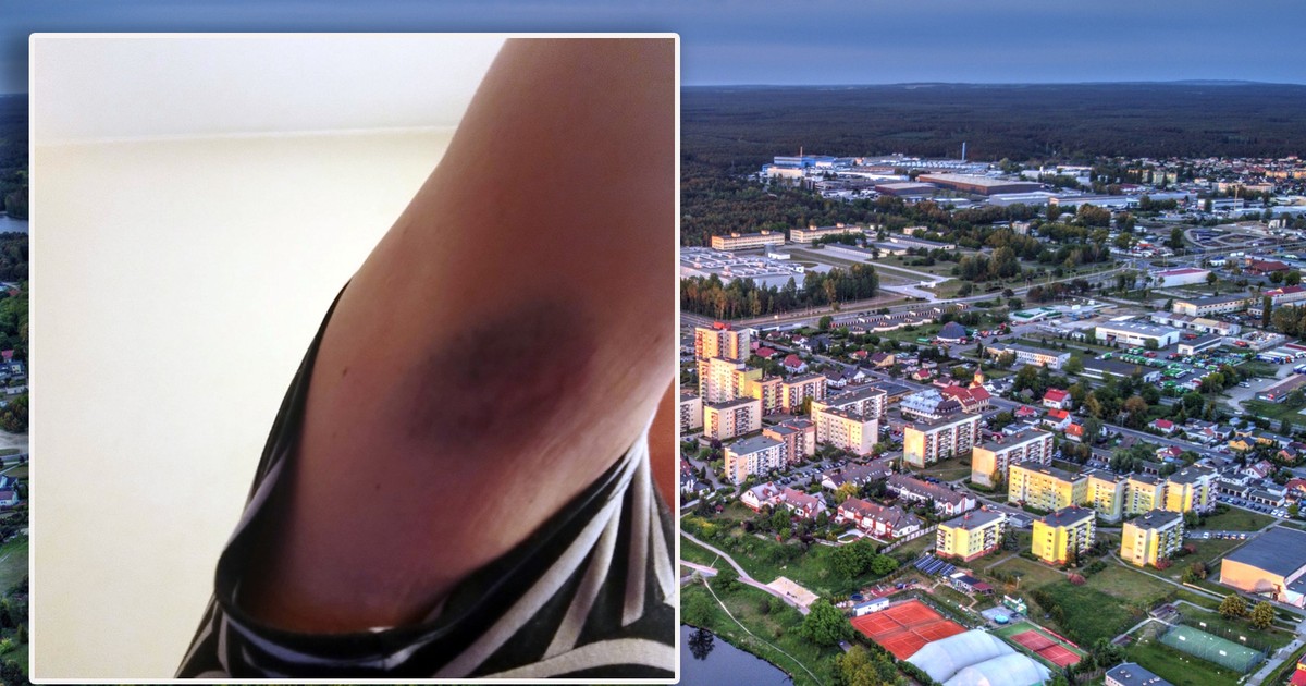 Miał być relaks, był groźny wypadek w aquaparku. "Bolesne poparzenie, stłuczenia"