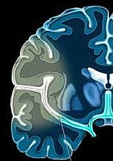 stroke-agy-d000013124e1b1d89418e