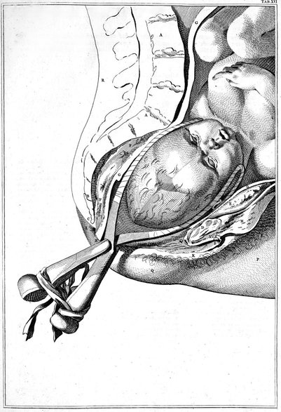 Rycina z książki na temat położnictwa z 1754 roku autorstwa Williama Smellie`a