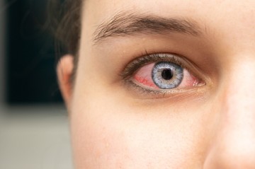 Allergia vagy fertőzés okozza kötőhártya-gyulladását? Így tehet különbséget köztük