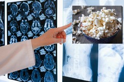 Popcornowe płuca. Brzmi niepoważnie, ale schorzenie jest bardzo groźne