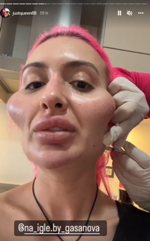 Anastasiia počas procedúry