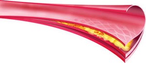 atheroma-d00000150fddbddec0595