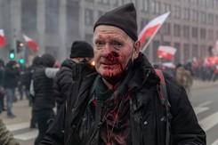 Zraniony przez policję fotoreporter: Będę żądał wysokiego odszkodowania. Może z sześcioma zerami