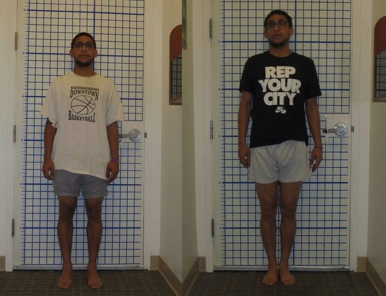 Leg lengthening is a trendy now [BBC]