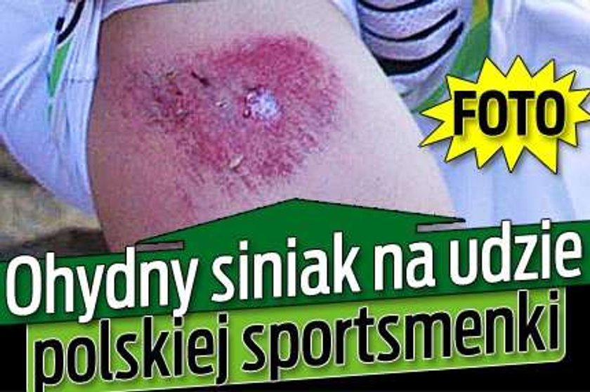 Ohydny siniak na udzie polskiej sportsmenki!