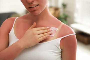 A bőr enyhe kivörösödését kezelje napozás utáni balzsammal vagy aloe vera géllel. Ez sok vizet és egy kevés zsírt is tartalmaz. Hűsítő és nyugtató hatású. Fájdalom és enyhe hőemelkedés esetén vegyen be fájdalomcsillapítót. Igyon sok folyadékot!
