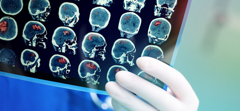Skuteczna terapia może hamować zanik tkanki mózgu u chorych na SM