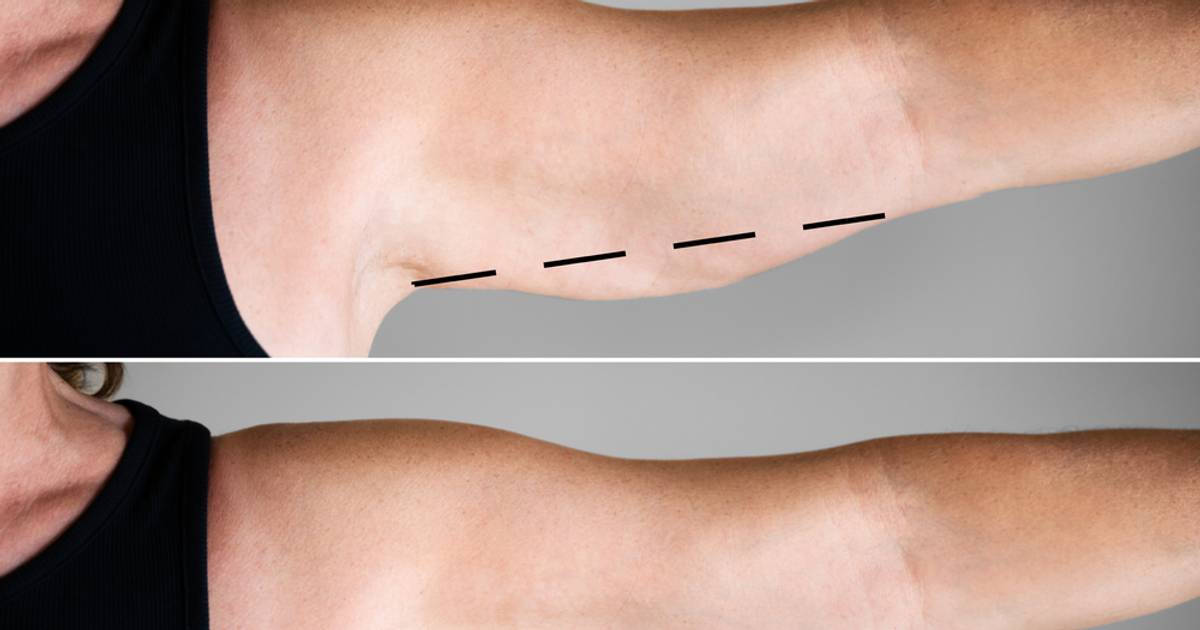 Jak się pozbyć "pelikanów"? To najlepszy sposób na obwisłą skórę na ramionach