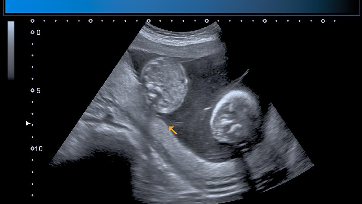 3. týždeň tehotenstva: Keď z vajíčka vzniknú identické dvojčatá -  Tehotenstvo | Najmama.sk