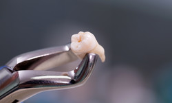 Kiedy odpada skrzep po wyrwaniu zęba? Ważne porady stomatologa