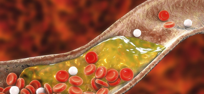 Wysoki poziom cholesterolu pomaga rozwijać się nowotworom