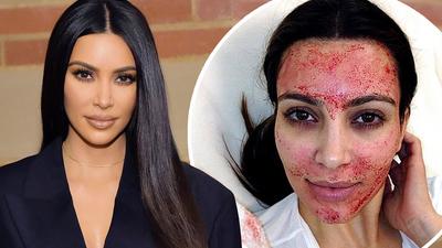 Kim K popularised vampire facials [Dailymail]