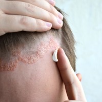 Pikkelysömör kezelése: 11 tipp, ami segít