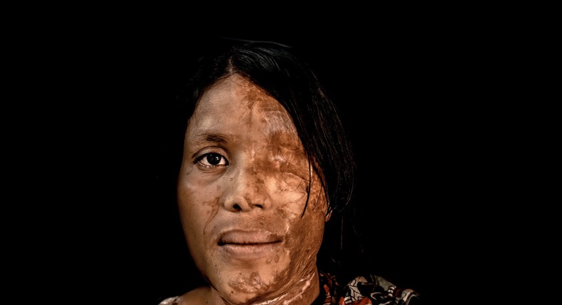 Woman attacked with acid