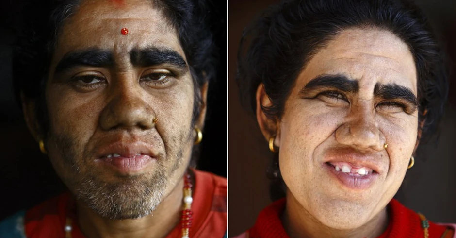 Devi Budatoki pre i posle zahvata