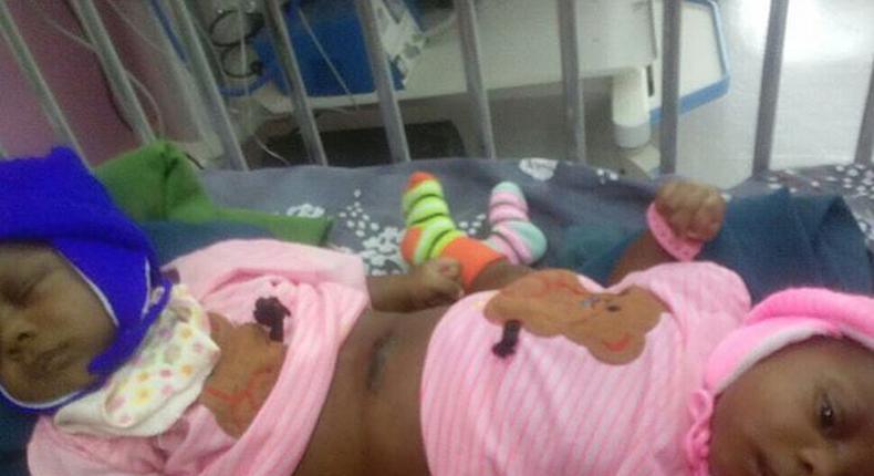 National Hospital records first conjoined twins separation/Illustration. [bellanaija]