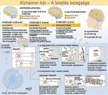 alzheimer-betegseg-kis-d0000107E068edbb6e9bb