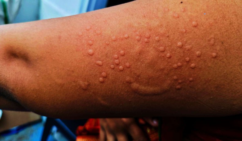 Symptoms of Mpox