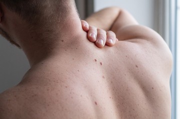 Óriási az igény az ingyenes SOTE digitális bőrdiagnosztikájára