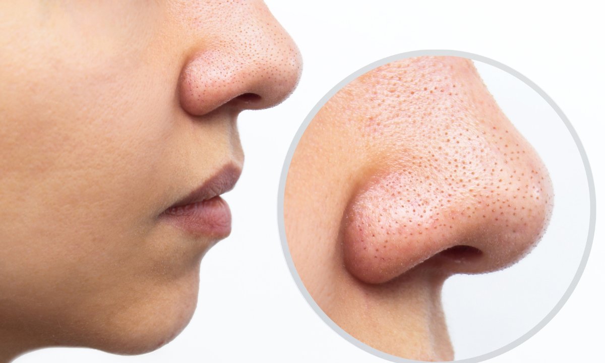 Ten peeling wyciąga zaskórniki jak odkurzacz! Pozbądź się w końcu czarnych kropek z nosa