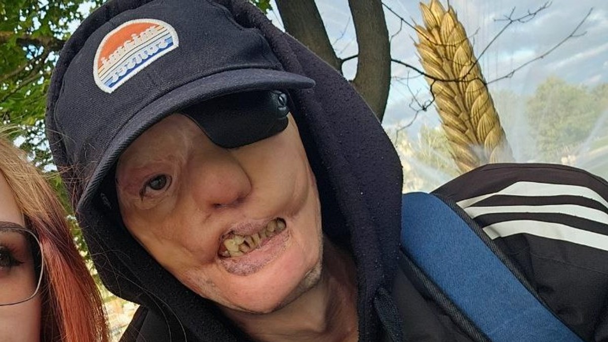 Igora (7) je majka ostavila samog sa stafordom koji mu je odgrizao pola lica