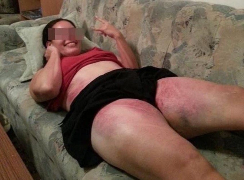 Sve je u redu: Turistkinja prekrivena modricama pozira za fotografisanje (FOTO: Vijesti.ba)