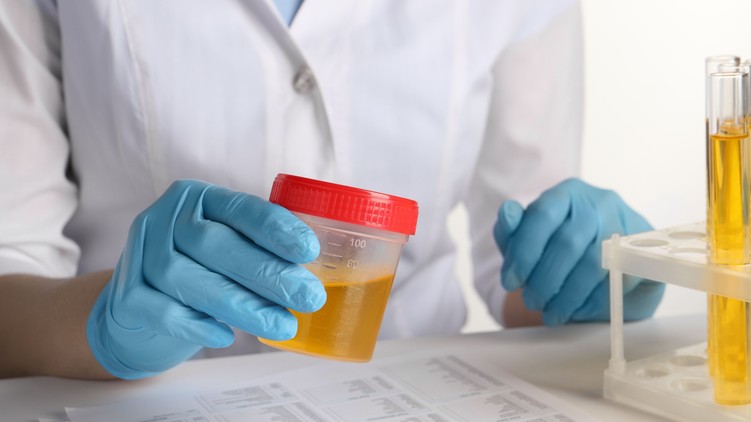 cukorbetegség vizelet mikroalbumin vizsgálat szűrés
