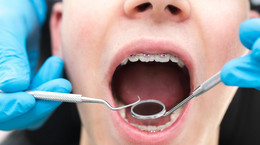 Co warto wiedzieć o klasycznych aparatach ortodontycznych?