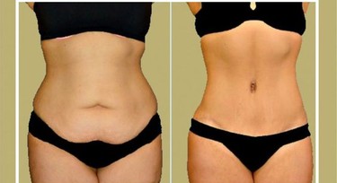 5 types of tummy fat, and how to get rid of them