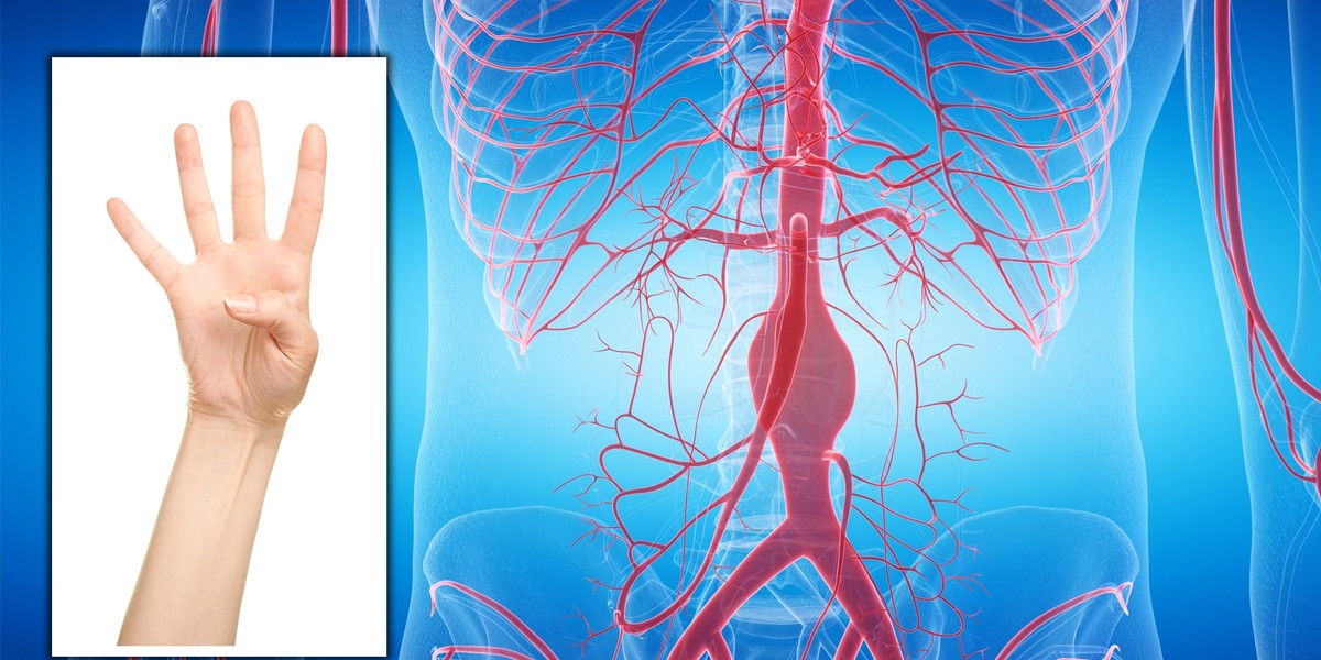 Prosty test kciuka może cię uchronić przed tętniakiem aorty.