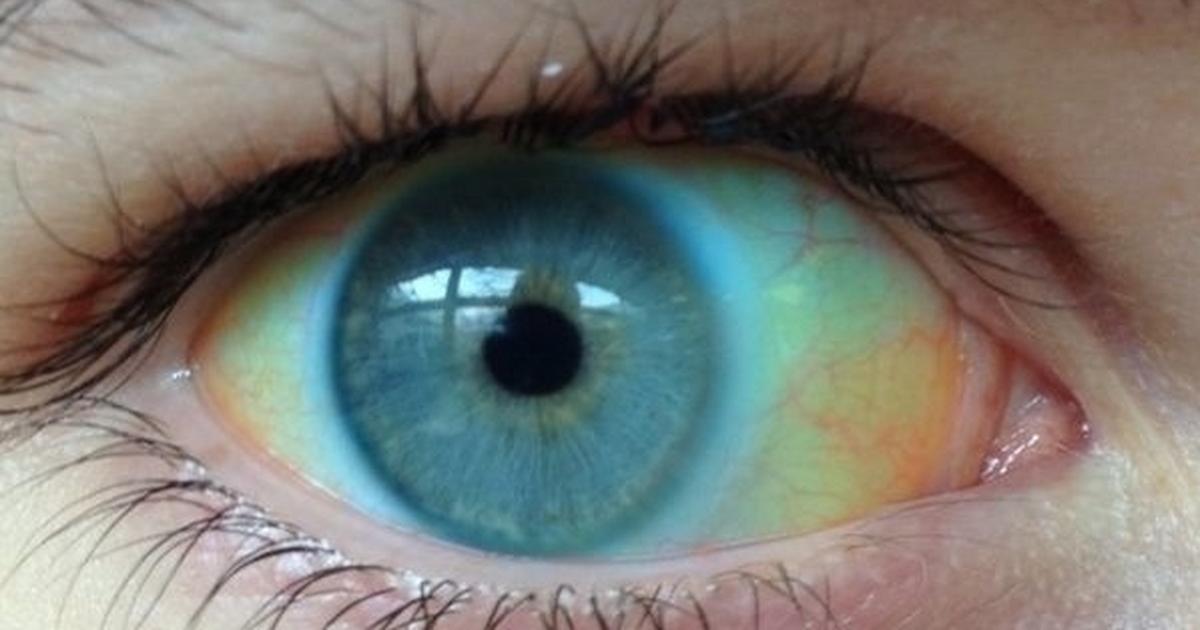Jakie Choroby Zdradzają Oczy Co Można Wyczytać Z Oczu 4441