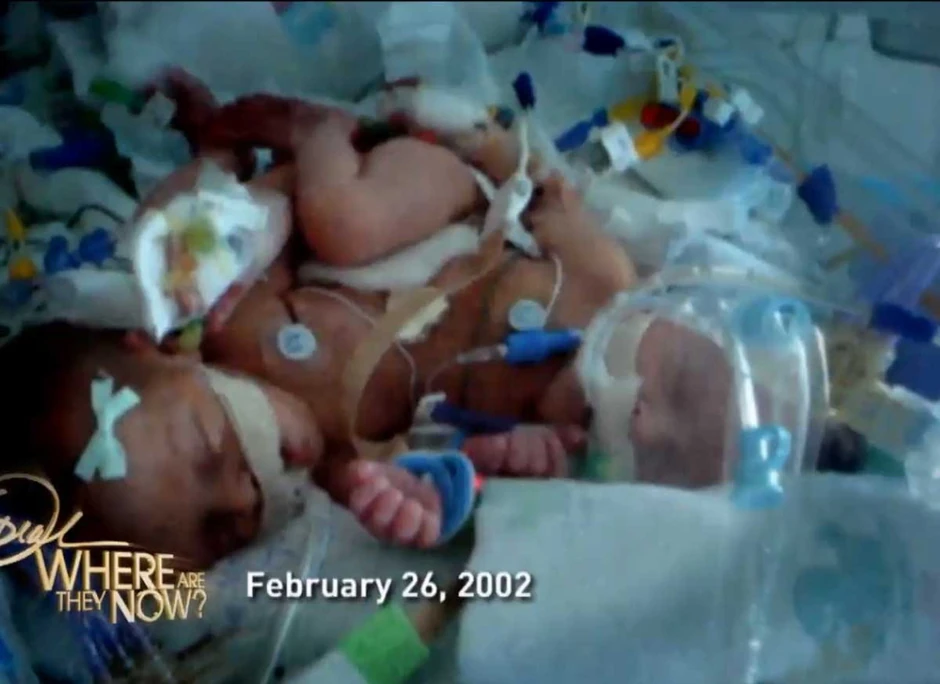 Postale su prve uspešno razdvojene bliznakinje koje su delile jedan bubreg