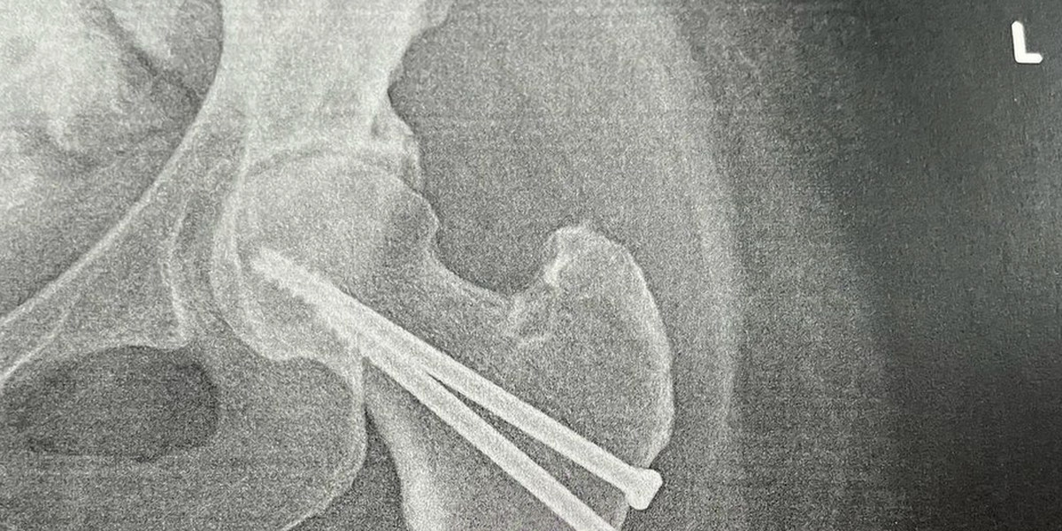 Zdjęcie rentgenowskie biodra Marty Kuligowskiej. Prezenterka doznała poważnego urazu na nartach.