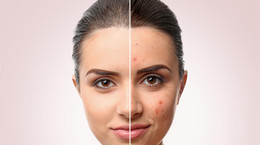 Zmiany skórne na twarzy - czy należy je usuwać?