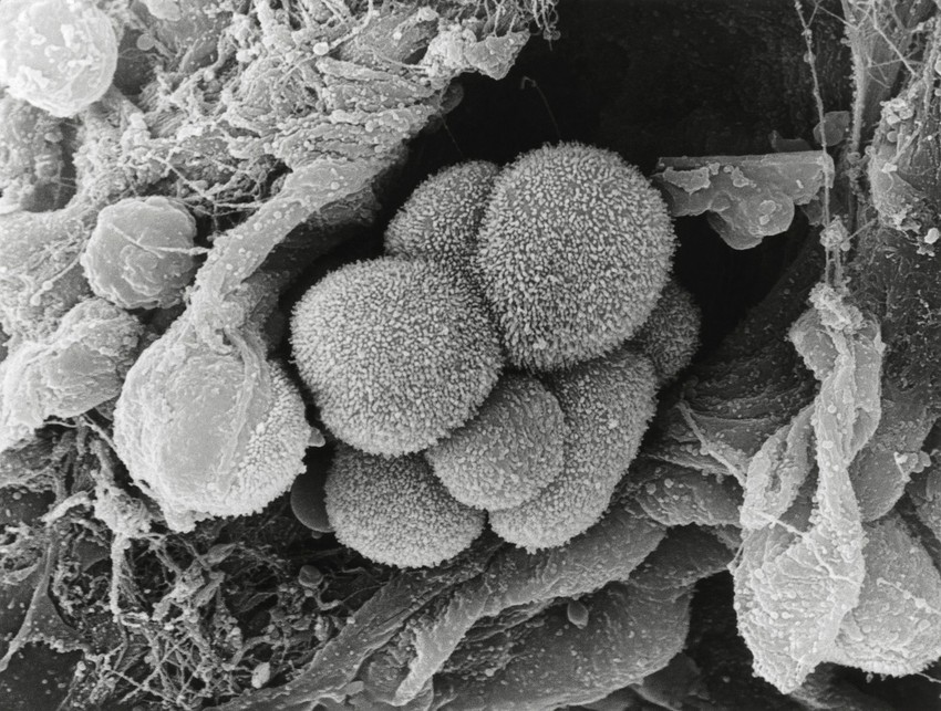 CT snimak raka pluća