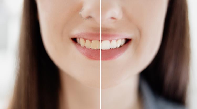 Így lehet újra ragyogóan fehér fogsorod. Fotó: Getty Images