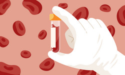 Co może być przyczyną podwyższonego kwasu moczowego we krwi?
