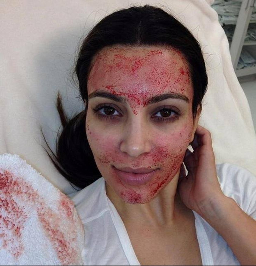 Kim Kardashian zrobiła sobie wampirzy lifting