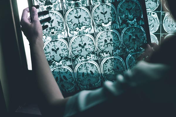 Alzheimer-gyógyítás epilepszia gyógyszerrel? Igen!