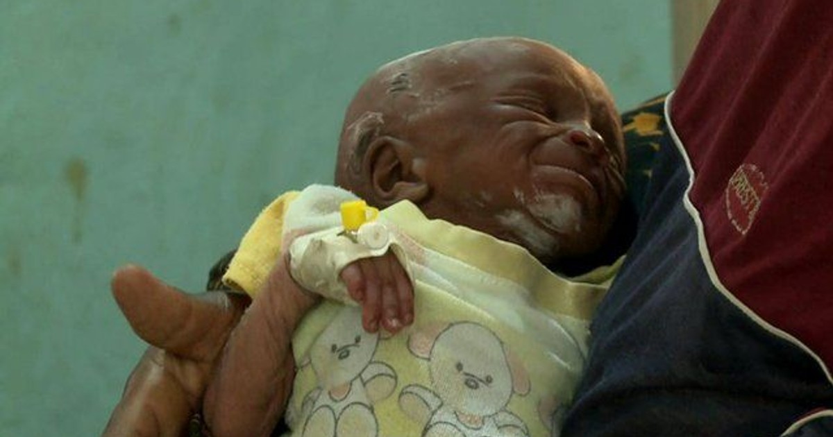 Lead Poisoning Over 150 affected children still undergoing treatment in Zamfara NGO [ARTICLE